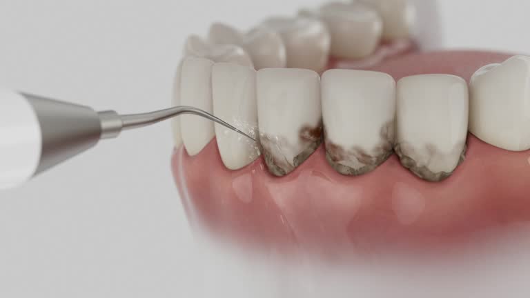 Trusted Wisdom Tooth Removal service in North Bonneville, WA - Dentist Open Now